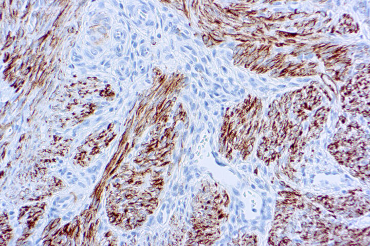 Immunohistochemical staining of Desmin  of human FFPE tissue followed by incubation with HRP labeled secondary and development with DAB substrate.