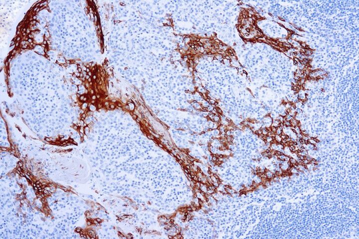 Immunohistochemical staining of Cytokeratin 16  of human FFPE tissue followed by incubation with HRP labeled secondary and development with DAB substrate.