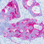 Immunohistochemical staining of Cytokeratin 20  of human FFPE tissue followed by incubation with HRP labeled secondary and development with DAB substrate.