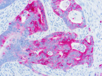 Immunohistochemical staining of Cytokeratin 20  of human FFPE tissue followed by incubation with HRP labeled secondary and development with DAB substrate.