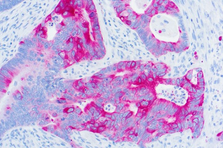 Immunohistochemical staining of Cytokeratin 20  of human FFPE tissue followed by incubation with HRP labeled secondary and development with DAB substrate.