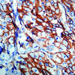 Immunohistochemical staining of Epithelial Antigen (EpCAM)  of human FFPE tissue followed by incubation with HRP labeled secondary and development with DAB substrate.