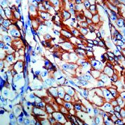 Immunohistochemical staining of Epithelial Antigen (EpCAM)  of human FFPE tissue followed by incubation with HRP labeled secondary and development with DAB substrate.