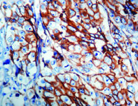 Immunohistochemical staining of Epithelial Antigen (EpCAM)  of human FFPE tissue followed by incubation with HRP labeled secondary and development with DAB substrate.