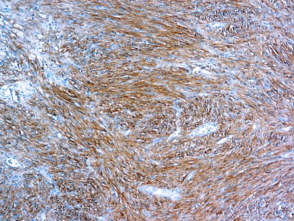 Immunohistochemical staining of DOG 1  of human FFPE tissue followed by incubation with HRP labeled secondary and development with DAB substrate.