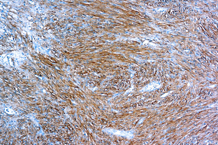 Immunohistochemical staining of DOG 1  of human FFPE tissue followed by incubation with HRP labeled secondary and development with DAB substrate.