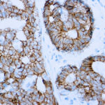 Immunohistochemical staining of E-Cadherin  of human FFPE tissue followed by incubation with HRP labeled secondary and development with DAB substrate.