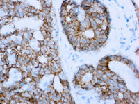 Immunohistochemical staining of E-Cadherin  of human FFPE tissue followed by incubation with HRP labeled secondary and development with DAB substrate.