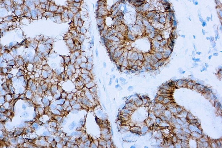 Immunohistochemical staining of E-Cadherin  of human FFPE tissue followed by incubation with HRP labeled secondary and development with DAB substrate.