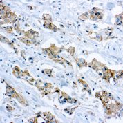 Immunohistochemical staining of E-Cadherin  of human FFPE tissue followed by incubation with HRP labeled secondary and development with DAB substrate.