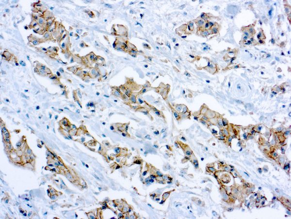 Immunohistochemical staining of E-Cadherin  of human FFPE tissue followed by incubation with HRP labeled secondary and development with DAB substrate.