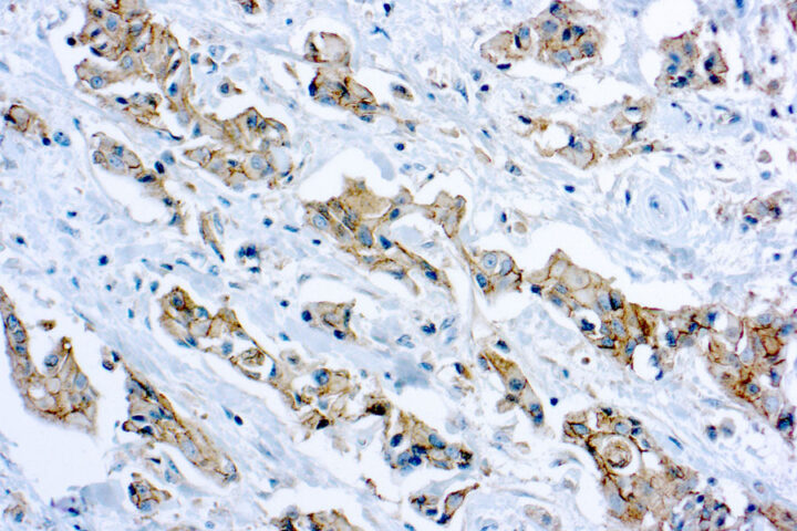 Immunohistochemical staining of E-Cadherin  of human FFPE tissue followed by incubation with HRP labeled secondary and development with DAB substrate.