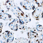 Immunohistochemical staining of Factor XIII-A  of human FFPE tissue followed by incubation with HRP labeled secondary and development with DAB substrate.