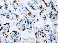 Immunohistochemical staining of Factor XIII-A  of human FFPE tissue followed by incubation with HRP labeled secondary and development with DAB substrate.