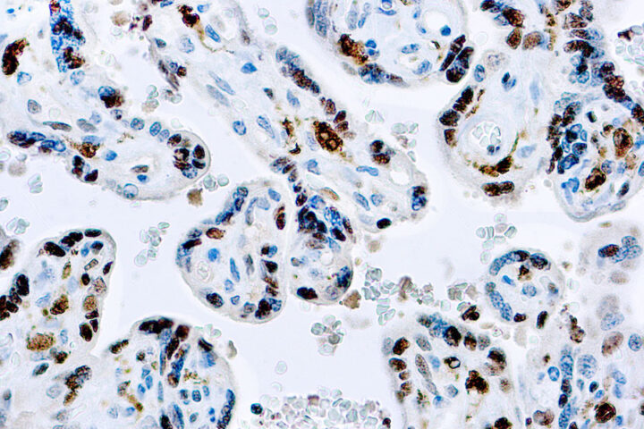 Immunohistochemical staining of Factor XIII-A  of human FFPE tissue followed by incubation with HRP labeled secondary and development with DAB substrate.