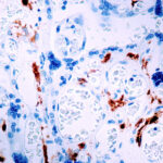 Immunohistochemical staining of Factor XIII-A  of human FFPE tissue followed by incubation with HRP labeled secondary and development with DAB substrate.