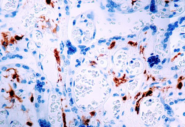 Immunohistochemical staining of Factor XIII-A  of human FFPE tissue followed by incubation with HRP labeled secondary and development with DAB substrate.