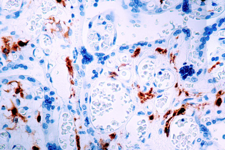 Immunohistochemical staining of Factor XIII-A  of human FFPE tissue followed by incubation with HRP labeled secondary and development with DAB substrate.