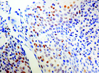 Immunohistochemical staining of ERCC1  of human FFPE tissue followed by incubation with HRP labeled secondary and development with DAB substrate.