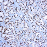 Immunohistochemical staining of ERG  of human FFPE tissue followed by incubation with HRP labeled secondary and development with DAB substrate.