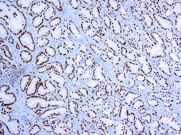 Immunohistochemical staining of ERG  of human FFPE tissue followed by incubation with HRP labeled secondary and development with DAB substrate.
