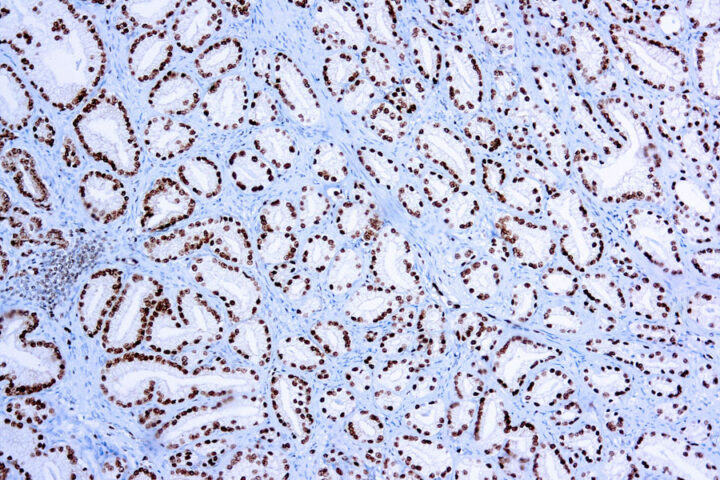 Immunohistochemical staining of ERG  of human FFPE tissue followed by incubation with HRP labeled secondary and development with DAB substrate.