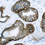 Immunohistochemical staining of Epithelial Antigen (EpCAM) (GMP) of human FFPE tissue followed by incubation with HRP labeled secondary and development with DAB substrate.