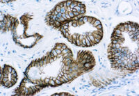 Immunohistochemical staining of Epithelial Antigen (EpCAM) (GMP) of human FFPE tissue followed by incubation with HRP labeled secondary and development with DAB substrate.