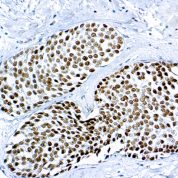 Immunohistochemical staining of GATA3  of human FFPE tissue followed by incubation with HRP labeled secondary and development with DAB substrate.