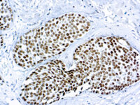 Immunohistochemical staining of GATA3  of human FFPE tissue followed by incubation with HRP labeled secondary and development with DAB substrate.