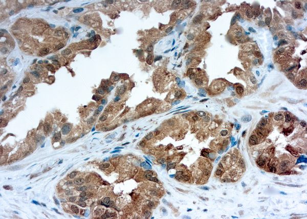 Immunohistochemical staining of Galectin-3  of human FFPE tissue followed by incubation with HRP labeled secondary and development with DAB substrate.