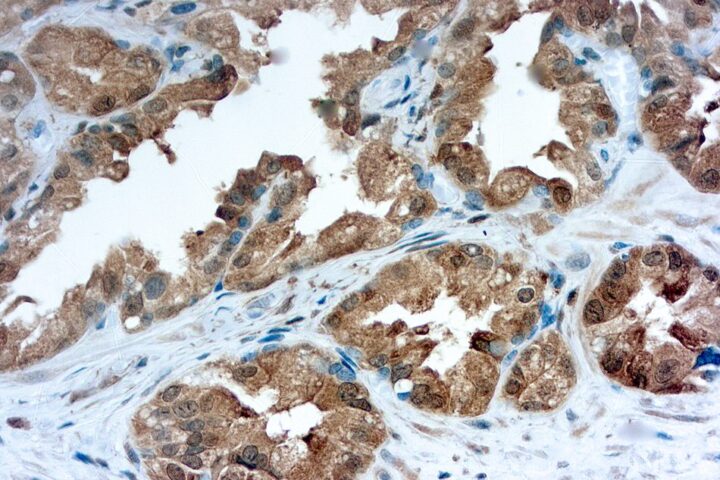 Immunohistochemical staining of Galectin-3  of human FFPE tissue followed by incubation with HRP labeled secondary and development with DAB substrate.