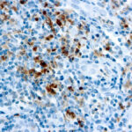 Immunohistochemical staining of Granzyme B  of human FFPE tissue followed by incubation with HRP labeled secondary and development with DAB substrate.