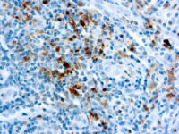 Immunohistochemical staining of Granzyme B  of human FFPE tissue followed by incubation with HRP labeled secondary and development with DAB substrate.