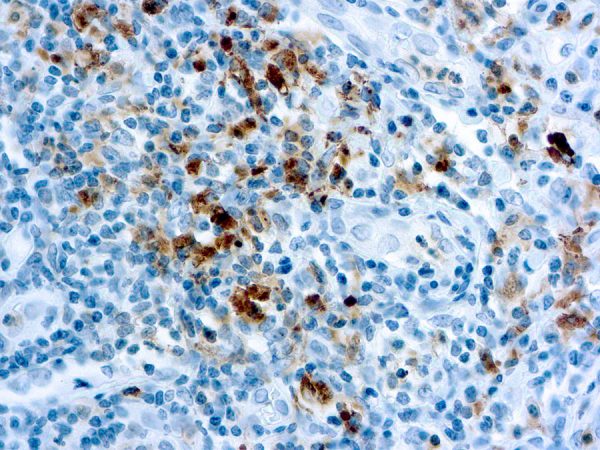 Immunohistochemical staining of Granzyme B  of human FFPE tissue followed by incubation with HRP labeled secondary and development with DAB substrate.
