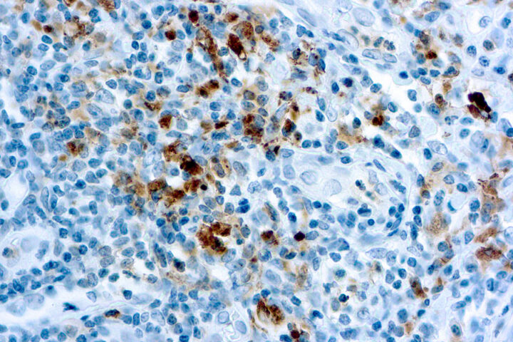 Immunohistochemical staining of Granzyme B  of human FFPE tissue followed by incubation with HRP labeled secondary and development with DAB substrate.