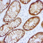 Immunohistochemical staining of Epithelial Antigen (EpCAM)  of human FFPE tissue followed by incubation with HRP labeled secondary and development with DAB substrate.