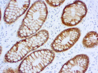 Immunohistochemical staining of Epithelial Antigen (EpCAM)  of human FFPE tissue followed by incubation with HRP labeled secondary and development with DAB substrate.