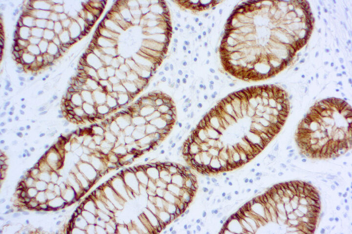 Immunohistochemical staining of Epithelial Antigen (EpCAM)  of human FFPE tissue followed by incubation with HRP labeled secondary and development with DAB substrate.