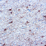 Immunohistochemical staining of Glial Fibrillary Acidic Protein  of human FFPE tissue followed by incubation with HRP labeled secondary and development with DAB substrate.