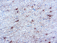 Immunohistochemical staining of Glial Fibrillary Acidic Protein  of human FFPE tissue followed by incubation with HRP labeled secondary and development with DAB substrate.