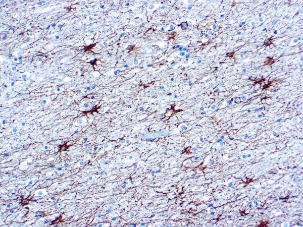 Immunohistochemical staining of Glial Fibrillary Acidic Protein  of human FFPE tissue followed by incubation with HRP labeled secondary and development with DAB substrate.