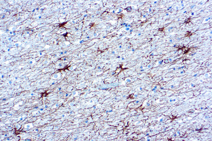 Immunohistochemical staining of Glial Fibrillary Acidic Protein  of human FFPE tissue followed by incubation with HRP labeled secondary and development with DAB substrate.