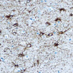 Immunohistochemical staining of Glial Fibrillary Acidic Protein  of human FFPE tissue followed by incubation with HRP labeled secondary and development with DAB substrate.