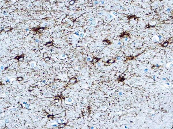 Immunohistochemical staining of Glial Fibrillary Acidic Protein  of human FFPE tissue followed by incubation with HRP labeled secondary and development with DAB substrate.