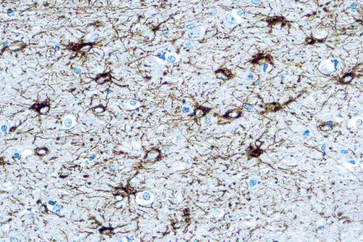 Immunohistochemical staining of Glial Fibrillary Acidic Protein  of human FFPE tissue followed by incubation with HRP labeled secondary and development with DAB substrate.