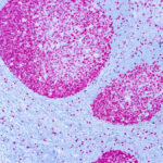 Immunohistochemical staining of Ki-67  of human FFPE tissue followed by incubation with HRP labeled secondary and development with DAB substrate.