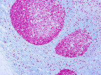 Immunohistochemical staining of Ki-67  of human FFPE tissue followed by incubation with HRP labeled secondary and development with DAB substrate.