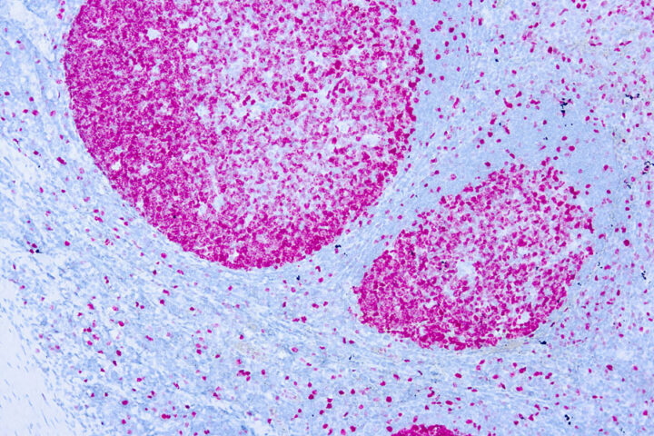 Immunohistochemical staining of Ki-67  of human FFPE tissue followed by incubation with HRP labeled secondary and development with DAB substrate.