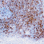 Immunohistochemical staining of Fascin-1  of human FFPE tissue followed by incubation with HRP labeled secondary and development with DAB substrate.